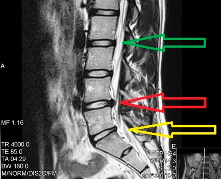 spine bulging disk xray
