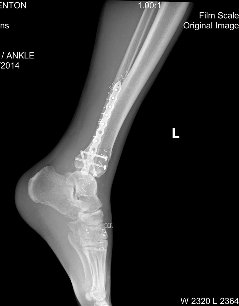 Broken Bone Lawyers: Leg Fractures | Hamilton & Associates